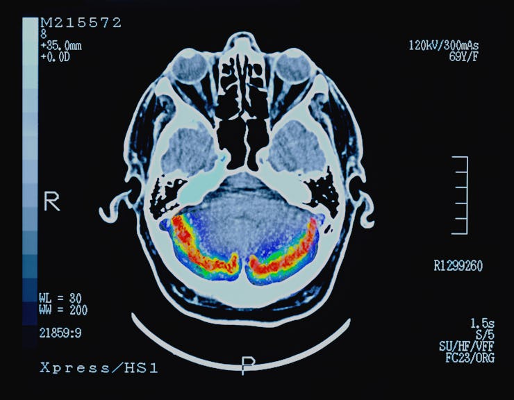 Brain scan shows problems