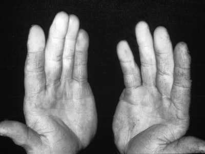 Photo of a patient with White Finger Disease due to working with a jackhammer, 1973. White Finger Di...