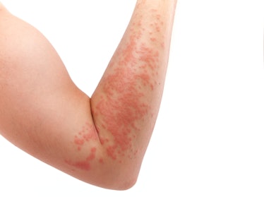 Arm covered in a skin allergy,hives