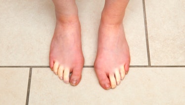 loss of blood flow due to bad circulation causing pale looking toes