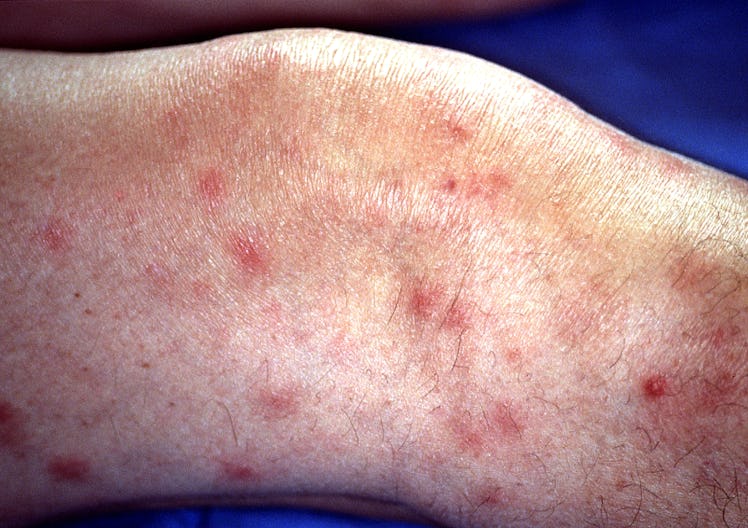 Panniculitis, An Inflammatory Necrotizing Reaction Of The Subcutaneous Fat. (Photo By BSIP/UIG Via G...
