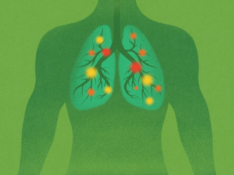 Illustration of human chest with lungs. The concept of respiratory diseases. Cancer disease concept.