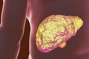 Liver with cirrhosis, computer illustration. Cirrhosis is a consequence of chronic liver disease cha...
