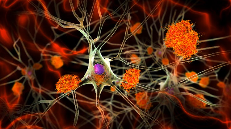 Alzheimer's disease. Illustration of amyloid plaques amongst neurons and neurofibrillary tangles ins...