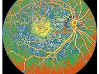 Retinal Fluorescein Angiogram Of Age Related Macular Degeneration. (Photo By BSIP/UIG Via Getty Imag...