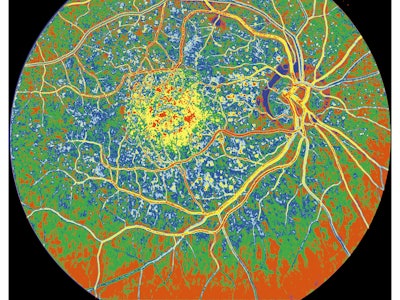 Retinal Fluorescein Angiogram Of Age Related Macular Degeneration. (Photo By BSIP/UIG Via Getty Imag...