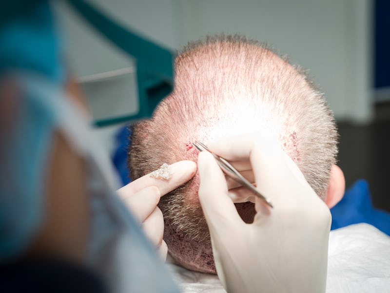 Nice, France, FUE, Follicular Unit Extraction, hair transplant on a patient with earlier two strip h...