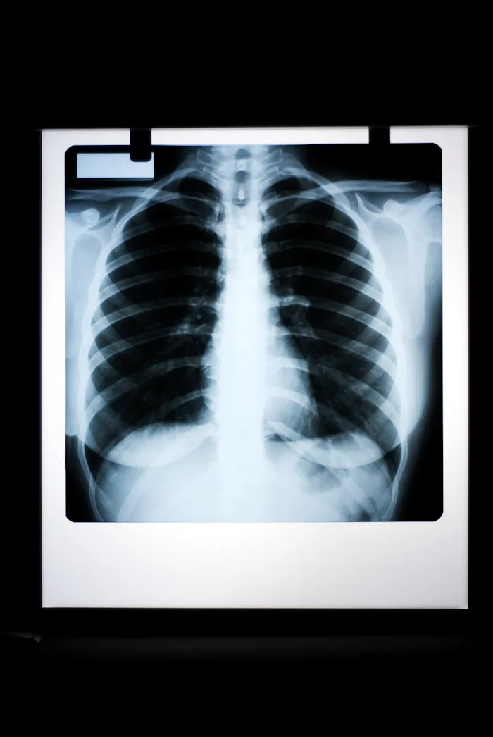 Posteroanterior normal lung graphy on a negatoscope.(Female)