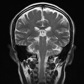 Coronal magnetic resonance imaging (MRI) scan of a normal human brain