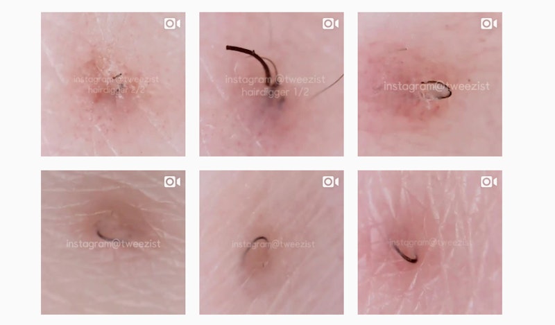 ingrown hair treatment Facial