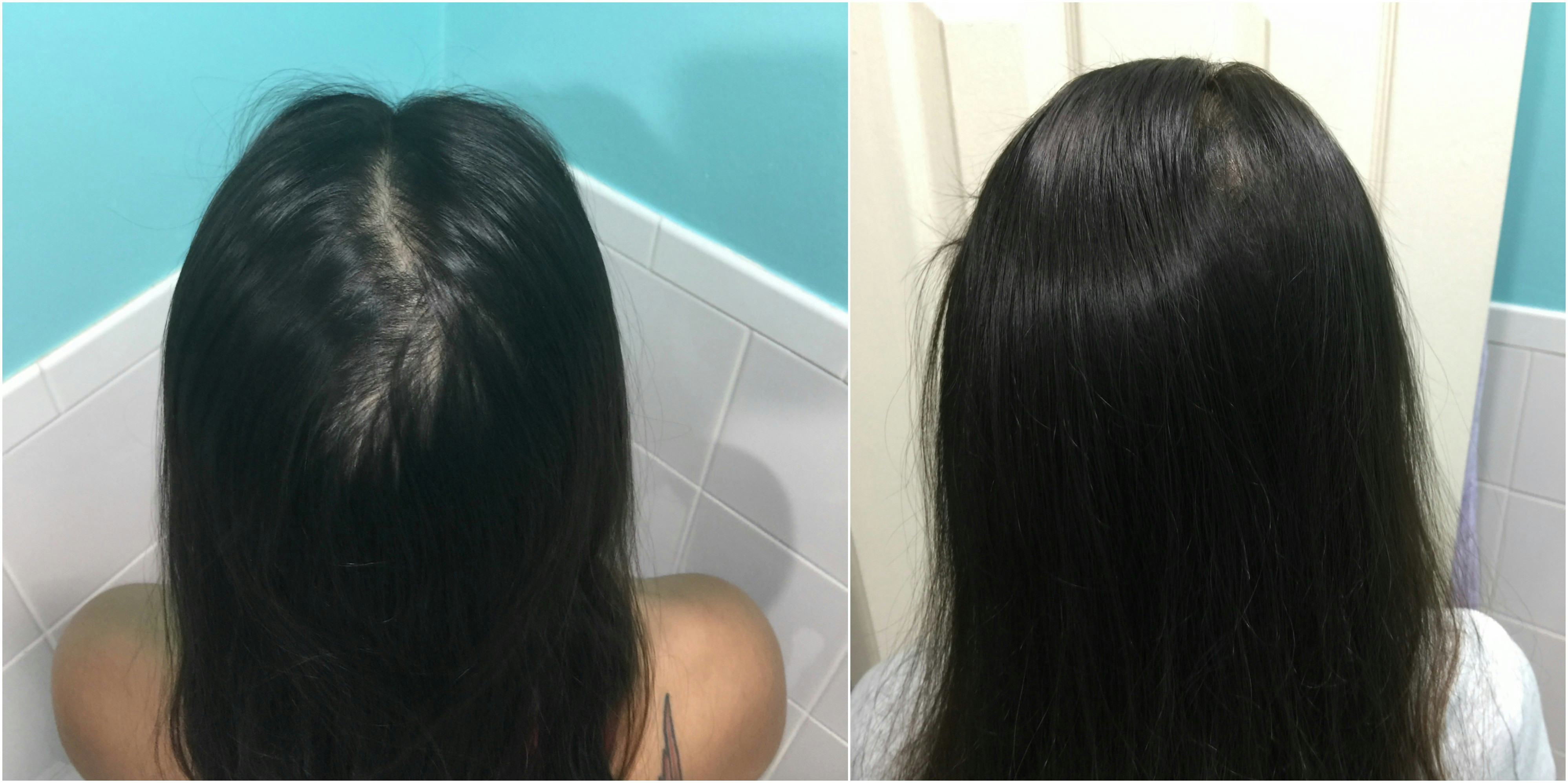 I Tried Gummy Vitamins To Fix My Postpartum Hair Loss & They Were