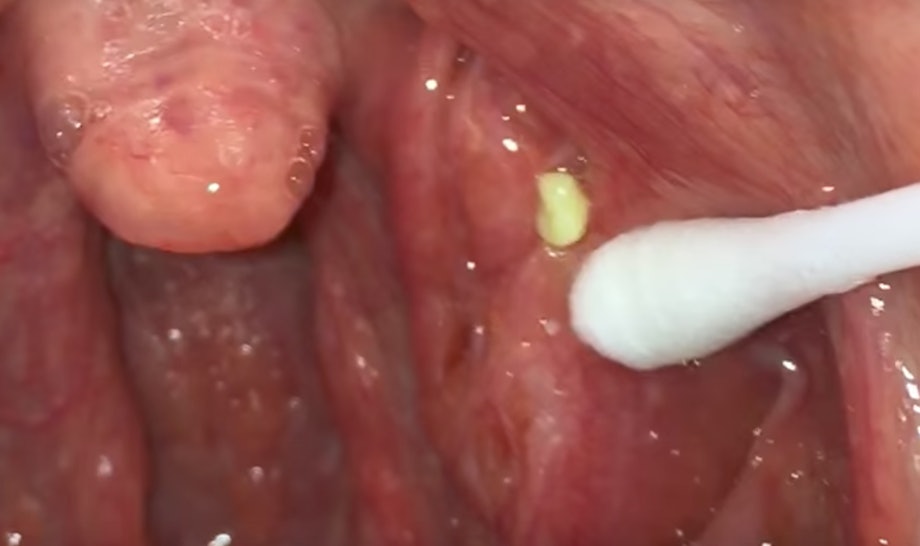 Tonsil Stone Removal Videos Are The New Pimple Popping Videos For