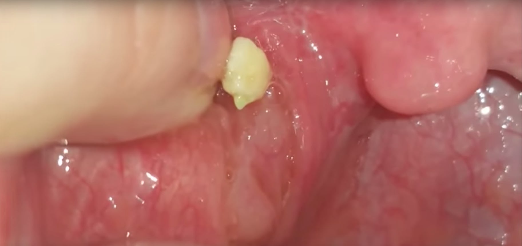 popping hidden tonsil stones