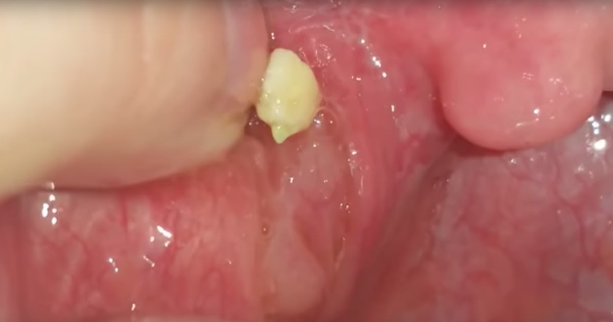 What Causes Tonsil Stones? If You Still Have Tonsils, You Basically Can