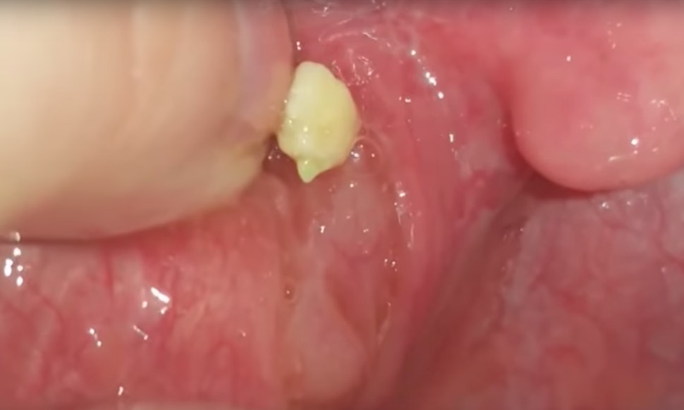 Does Getting Your Tonsils Removed Change Your Voice how to get rid of tonsil stones you can't see