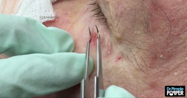 Dr. Pimple Popper Just Released Her Own Blackhead Tweezers — And Here's
