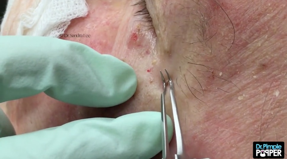 Dr Pimple Popper Just Released Her Own Blackhead Tweezers — And Here’s How They Work
