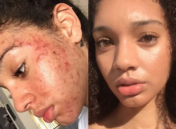 This Viral All-Natural Acne Cure Completely Cleared This Model's Skin ...