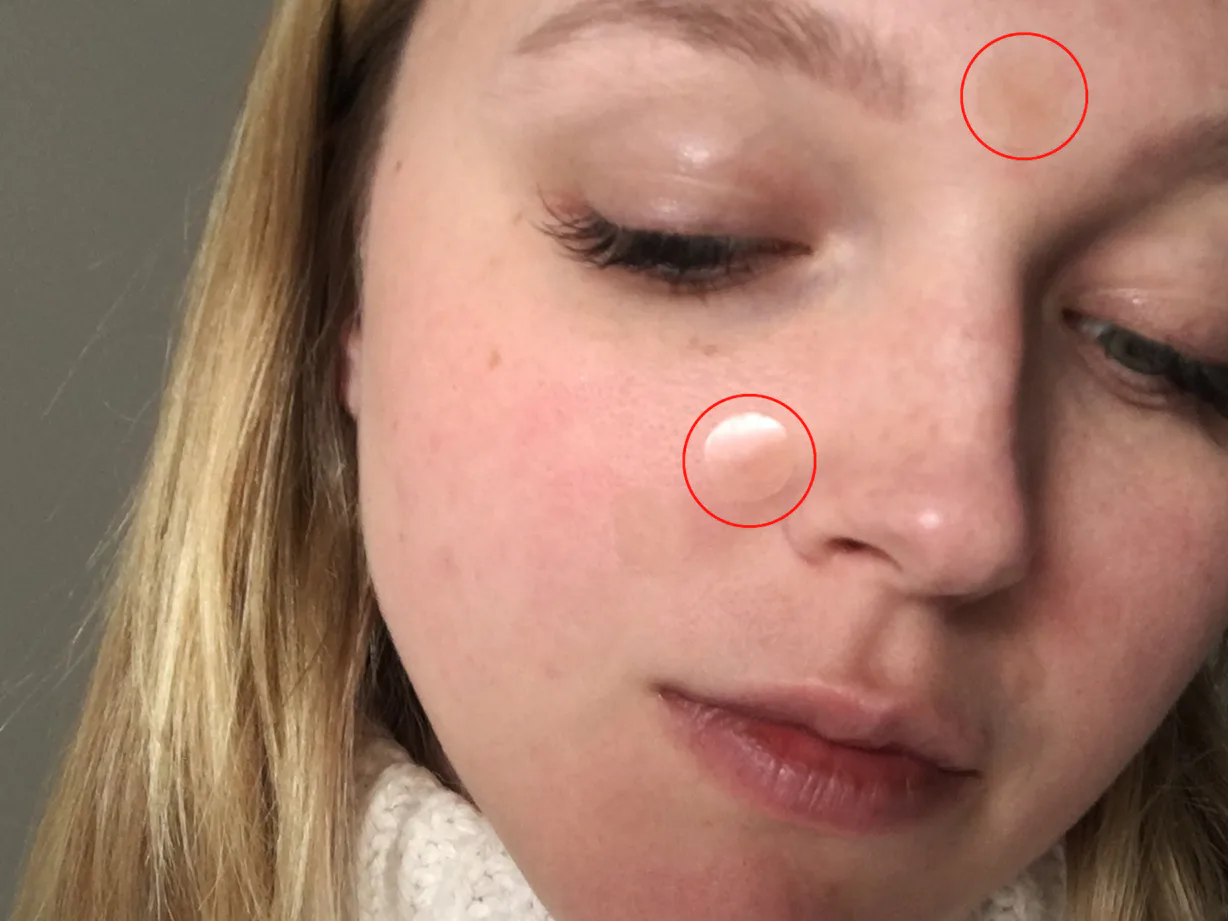 Do Acne Stickers Work These Korean Beauty Acne Dots Are My Best Friend do-acne-stickers-work-these-korean-beauty-acne-dots-are-my-best-friend