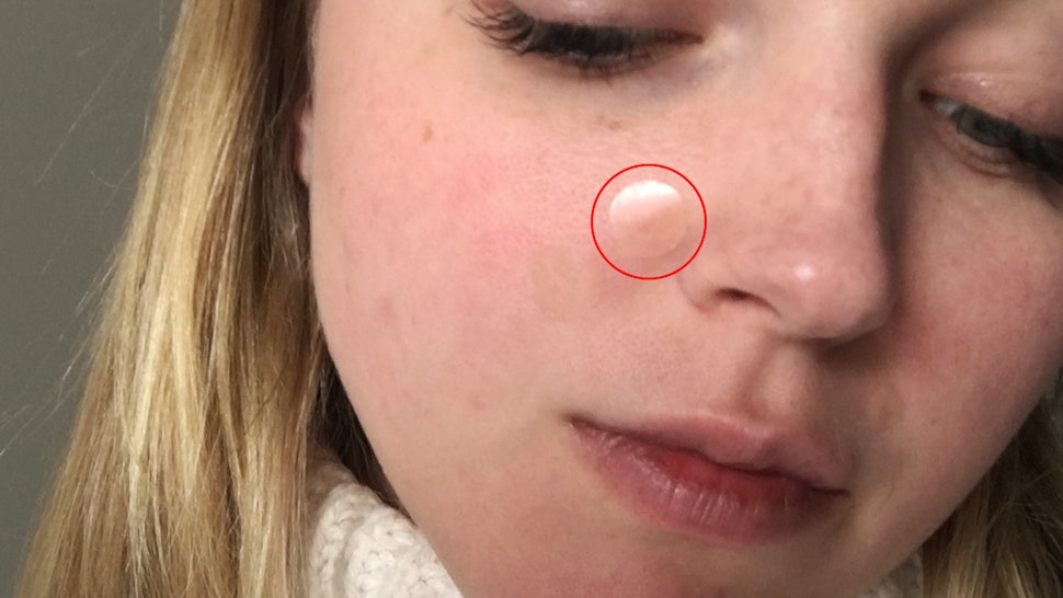 why use acne dots