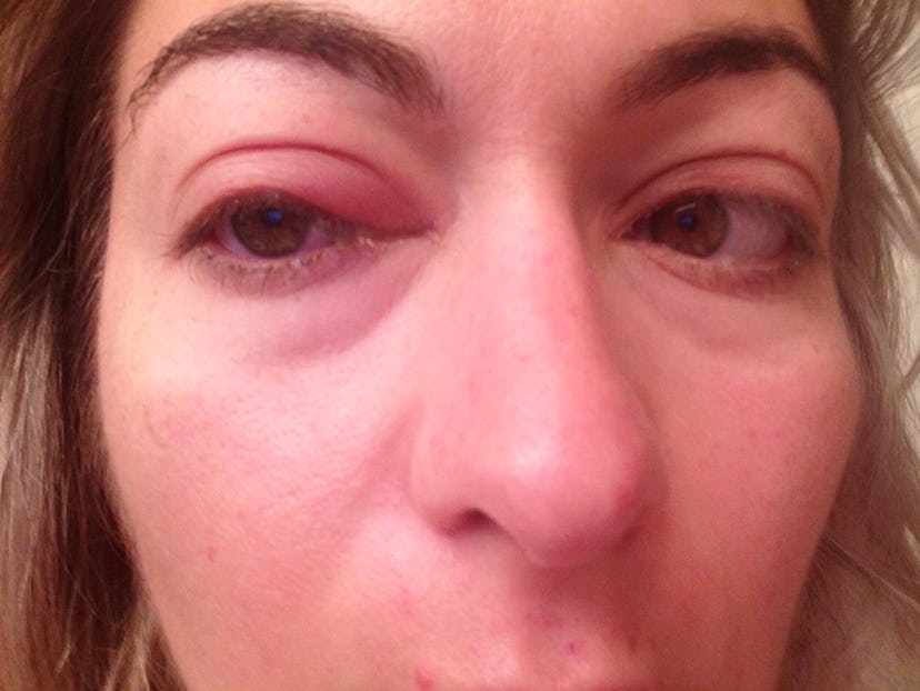The woman took a selfie of her red and swollen eye.