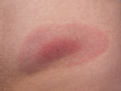Discoloration of the skin caused by a tick bite which might lead to lyme disease