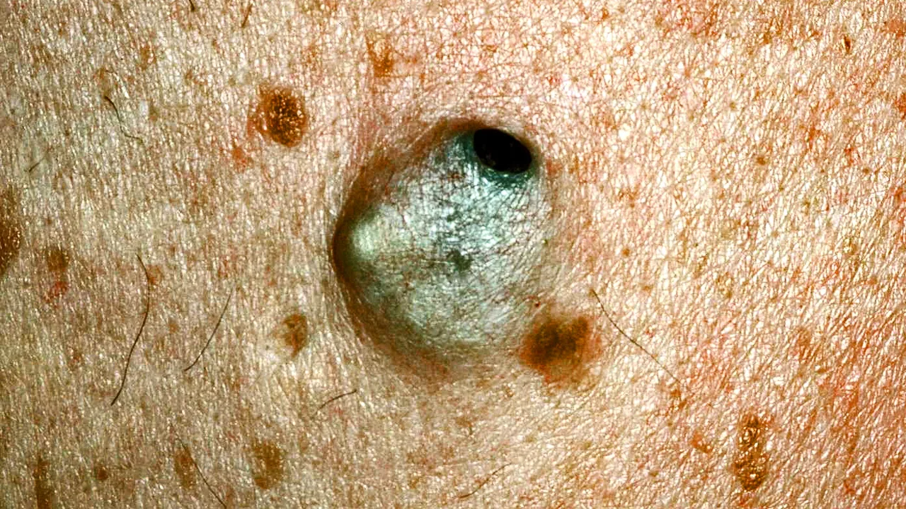 Pimple Popping Videos & 14 Other Gross Things People Are Obsessed With