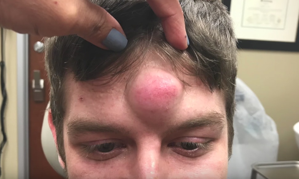 Dr Pimple dr pimple popper just removed a quot unicorn quot cyst you need Dr Pimple dr pimple popper just removed a quot unicorn quot cyst you need
