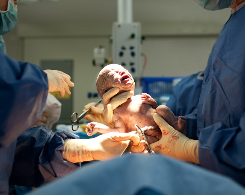 a woman getting a C-section, how long does a C-section take