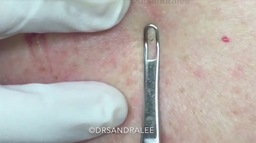 These Are Dr. Pimple Popper's Favorite Popping Videos For Beginner