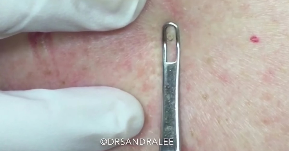 These Are Dr Pimple Popper S Favorite Popping Videos For Beginner