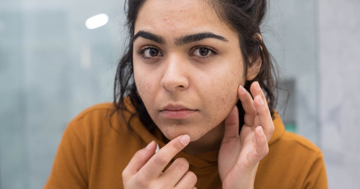 If You Have Acne In These 9 Places It Could Be A Sign Of These Other Health Conditions If You Have Acne In These 9 Places It Could Be A Sign Of These Other Health Conditions