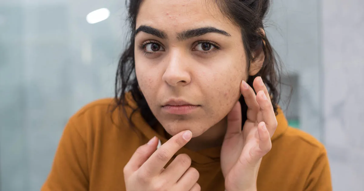If You Have Acne In These 9 Places It Could Be A Sign Of These Other Health Conditions