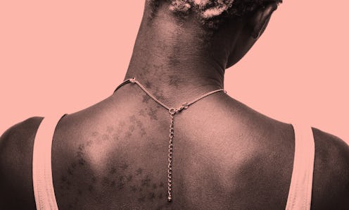 A back of a black woman who lost her hair during a cancer treatment 