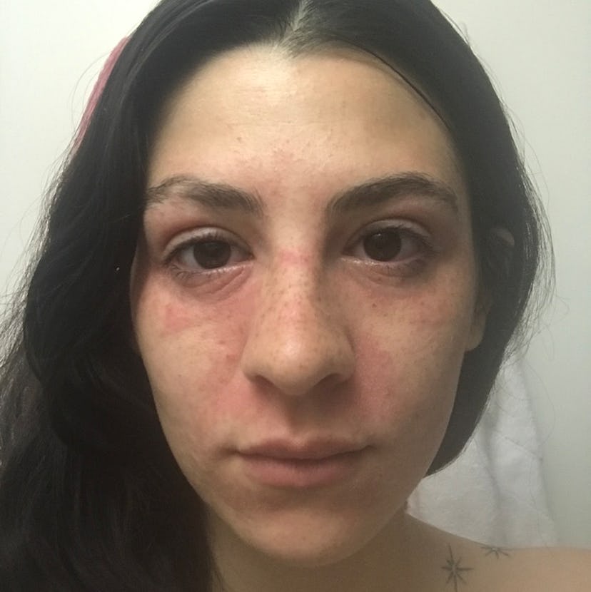 Skin damaged by steroid Cream