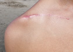 red scar on skin