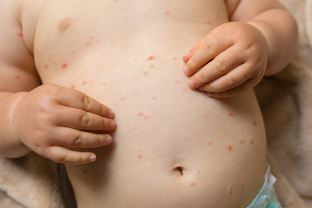 This State Is Having Its Worst Chickenpox Outbreak In 20 Years