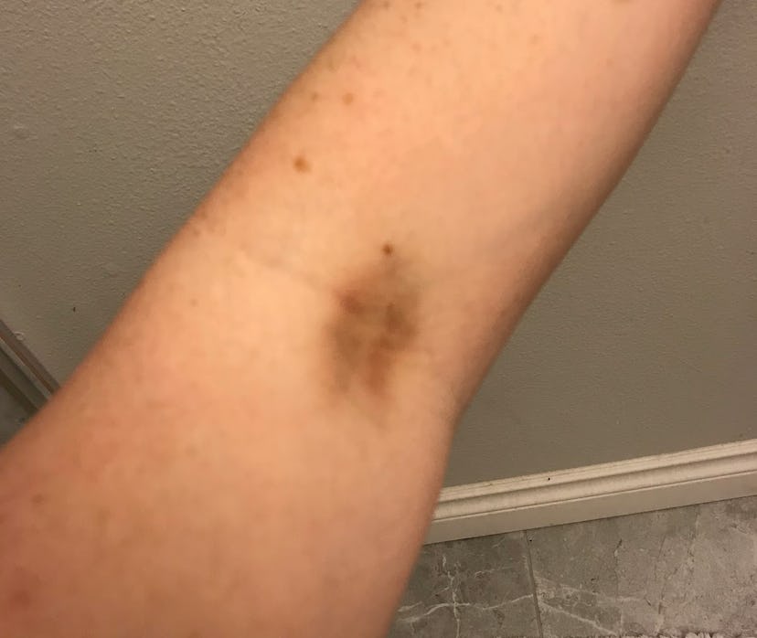 A close-up of Jessie Glockling's arm with a bruise after receiving a shot when she tried to conceive...