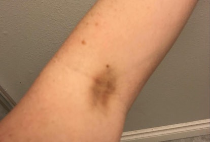 A close-up of Jessie Glockling's arm with a bruise after receiving a shot when she tried to conceive
