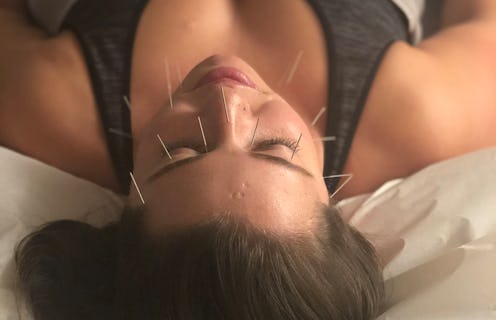 A woman lying on a bed during her facial acupuncture treatment.