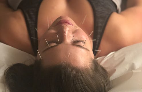 A woman lying on a bed during her facial acupuncture treatment.