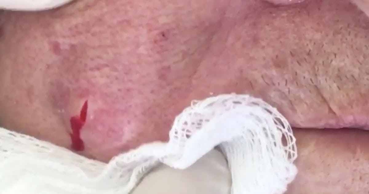 This Video Of A Giant Pimple Being Popped Is Going Viral On Reddit It S Easy To See Why This Video Of A Giant Pimple Being Popped Is Going Viral On Reddit It S Easy To See Why