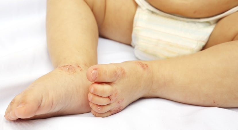 A baby having a rash on its legs as a result of hand, foot, and mouth disease