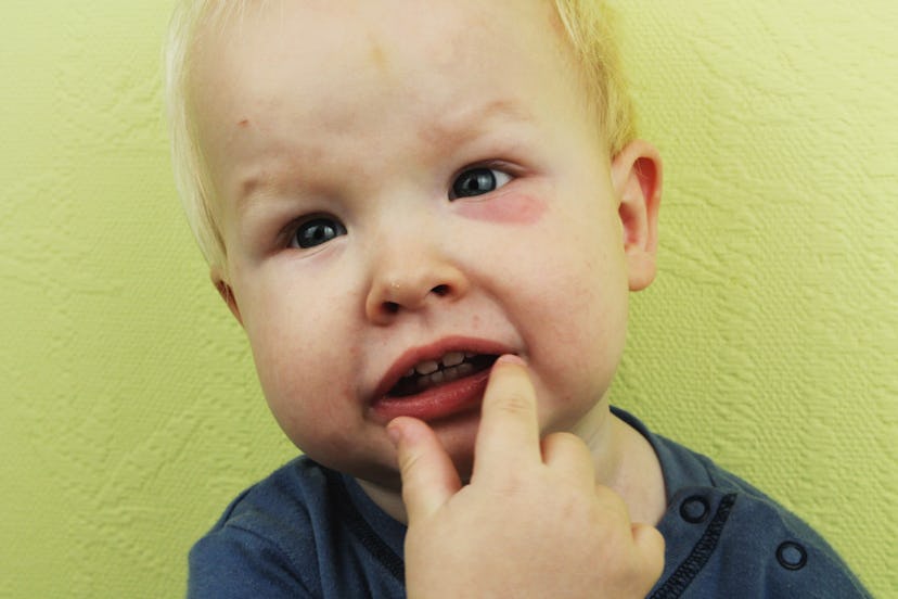 A boy with hives on his face