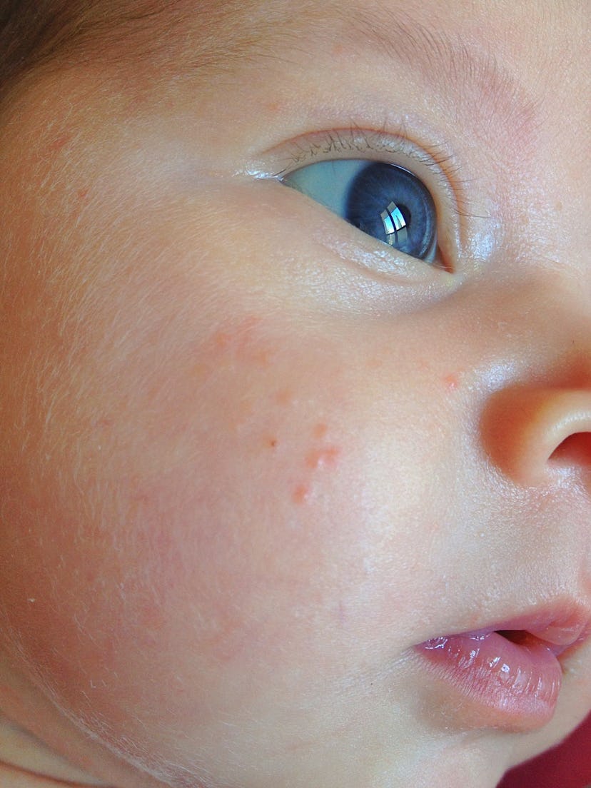 How To Treat A Baby Rash, According To Experts