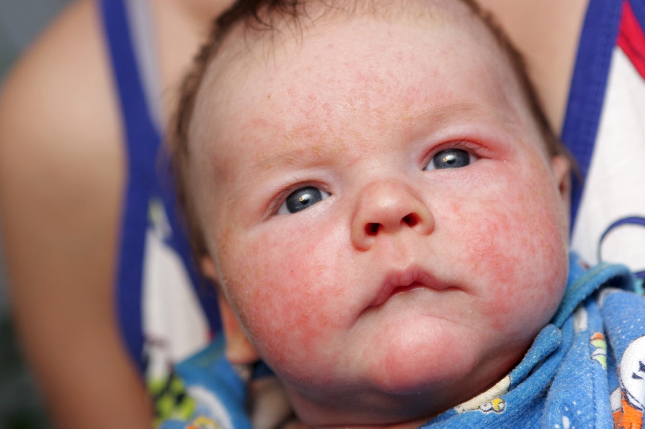 How To Treat A Baby Rash, According To Experts
