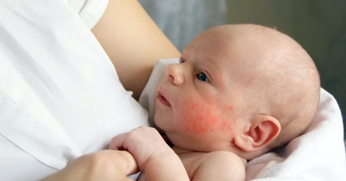 How To Treat A Baby Rash, According To Experts