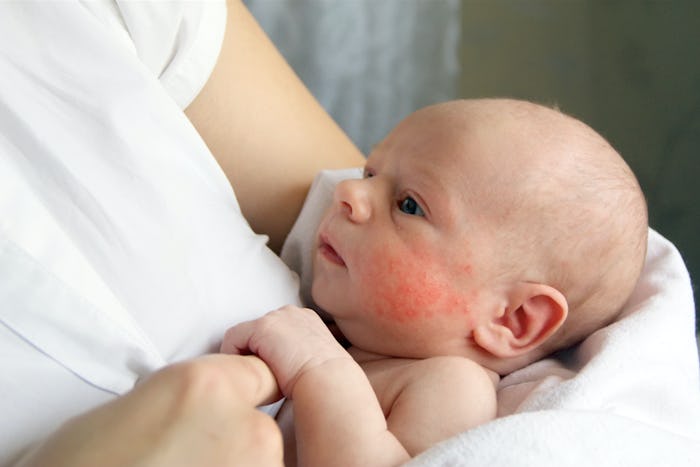A parent holding a baby with rash