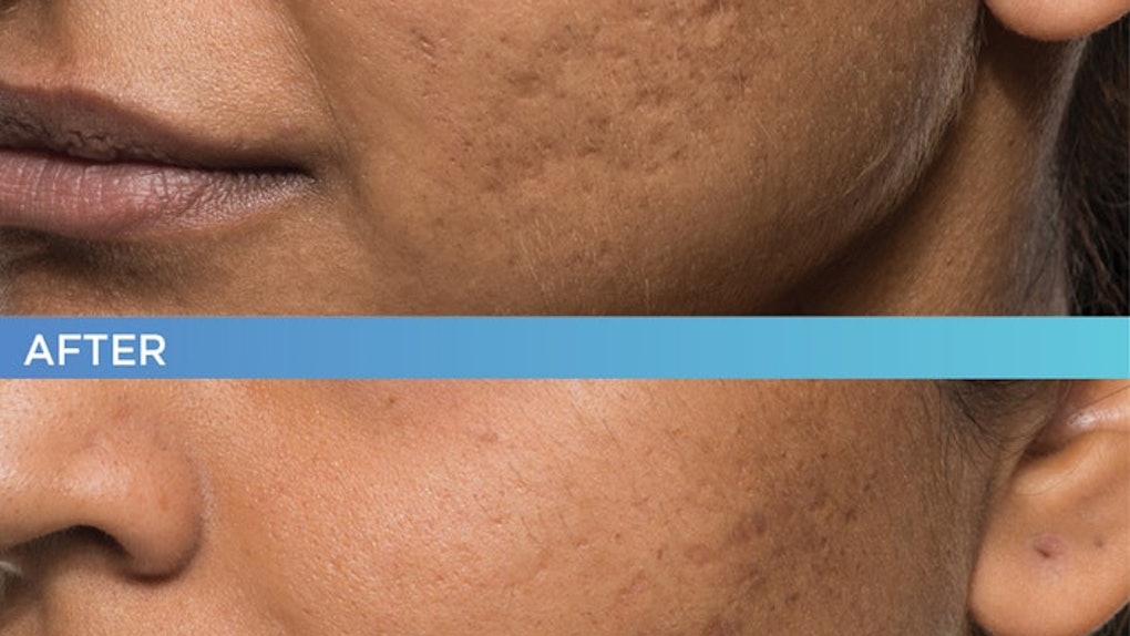 How To Get Rid Of Acne Scars For Good With Bellafill