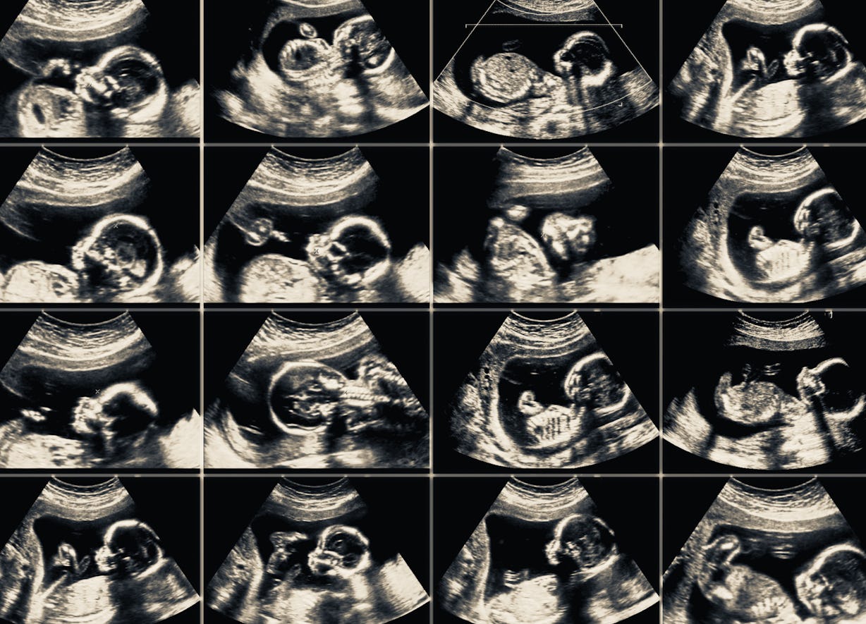 Early Miscarriage Pictures Facts And Healing For 4 6 Week Losses - sawpncq